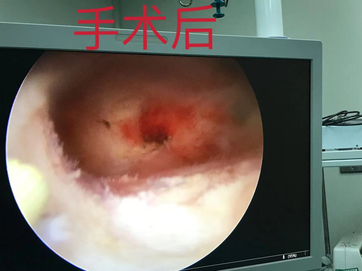 术后.JPG