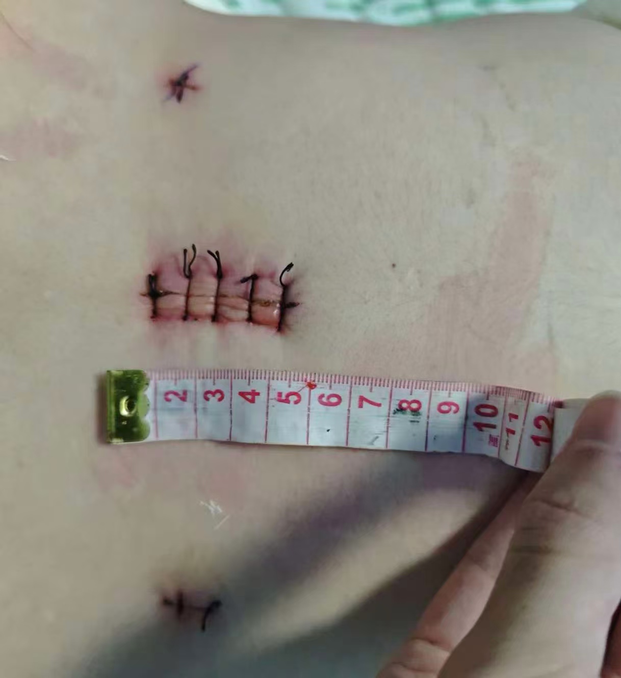 眼皮耷拉、浑身发软？警惕胸腺瘤“伪装”成体虚！市三医院巧施微创手术解难题